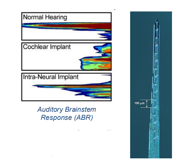 INI Cochlear Implant