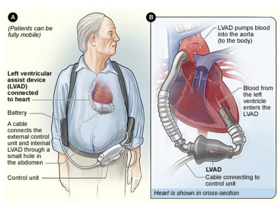 LVAD Diagram
