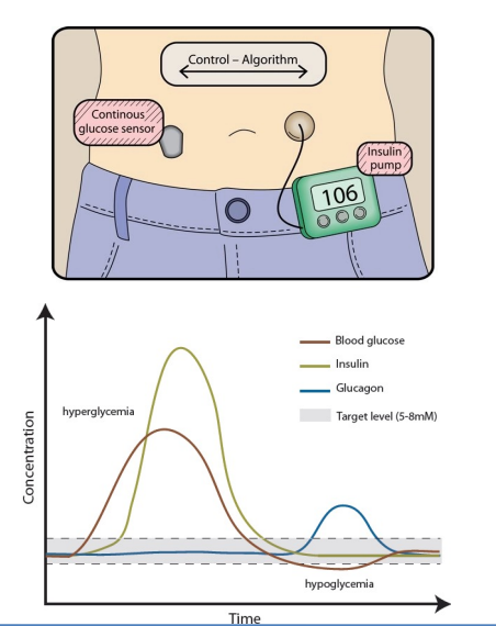 Artificial Pancreas