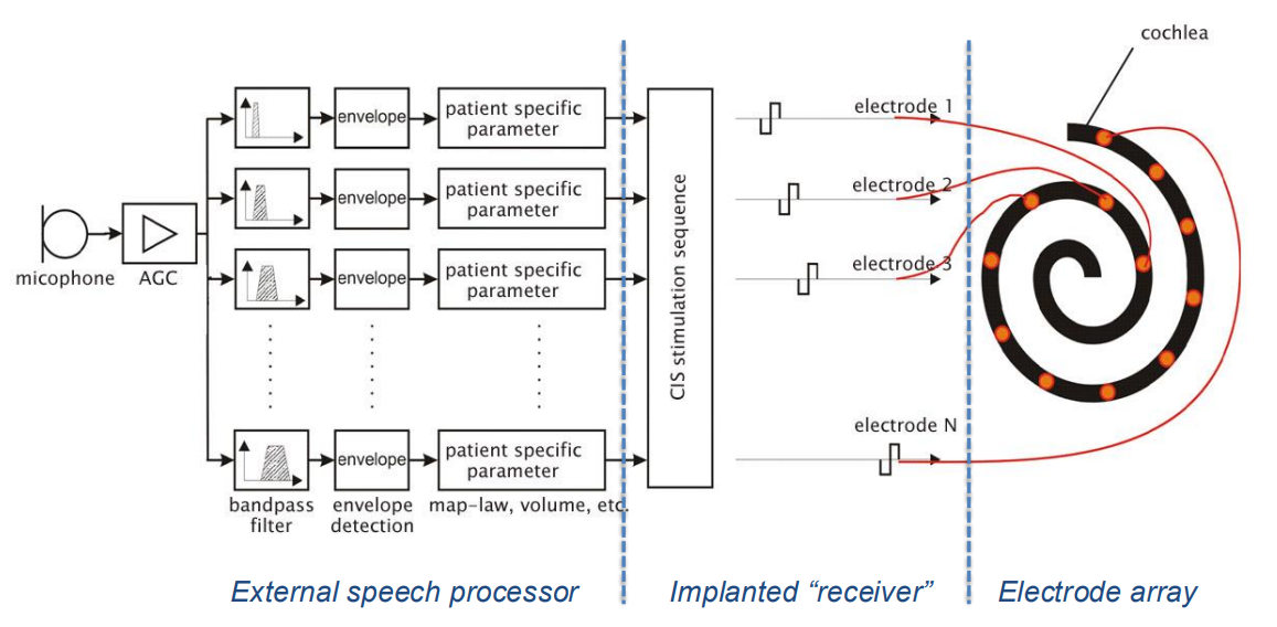 Block Diagram of Cochlear Implant