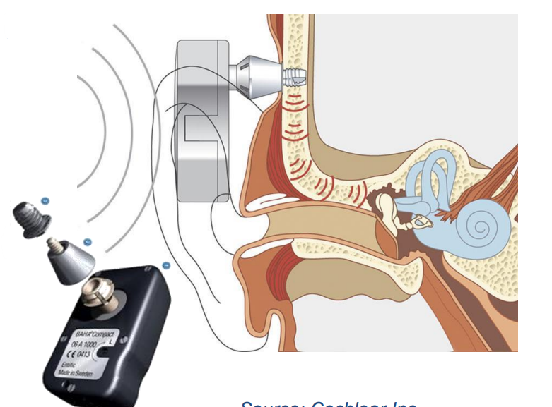 boneanchor Cochlear Implant