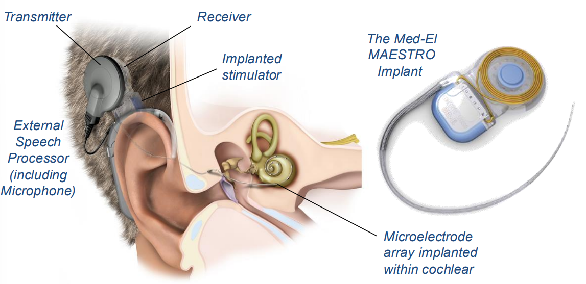 Diagram of Cochlear Implant
