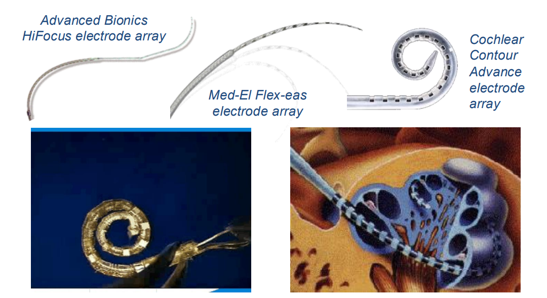 Diagram of Cochlear Implant and Electrode Array