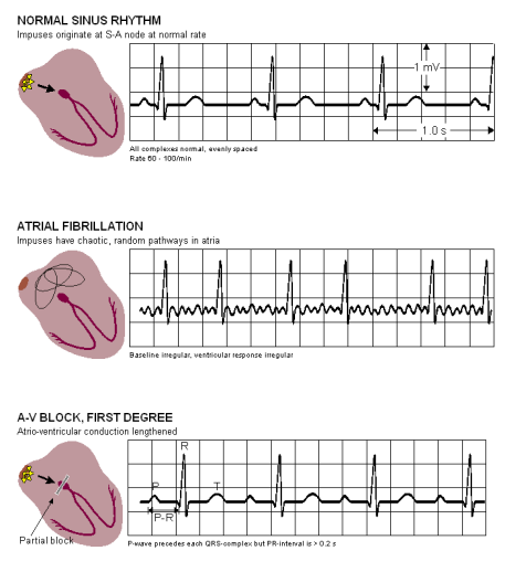 Heart Problems diagnosed by ECG