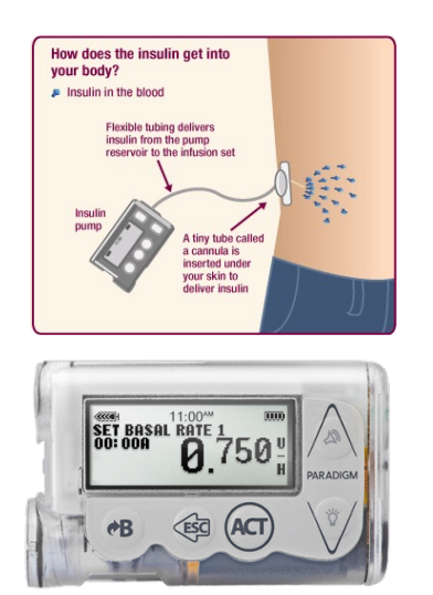 insulin pump