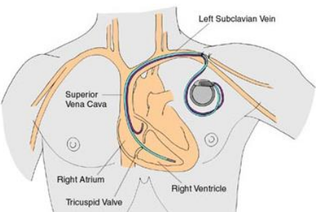 Pacemaker