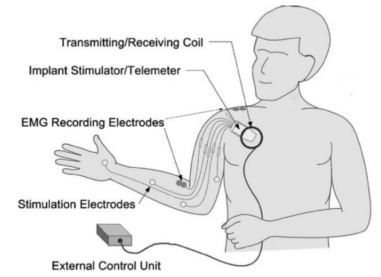 Paralysed FES Diagram