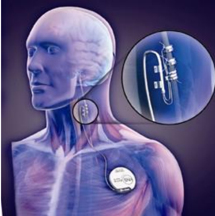 Vagus Nerve Image